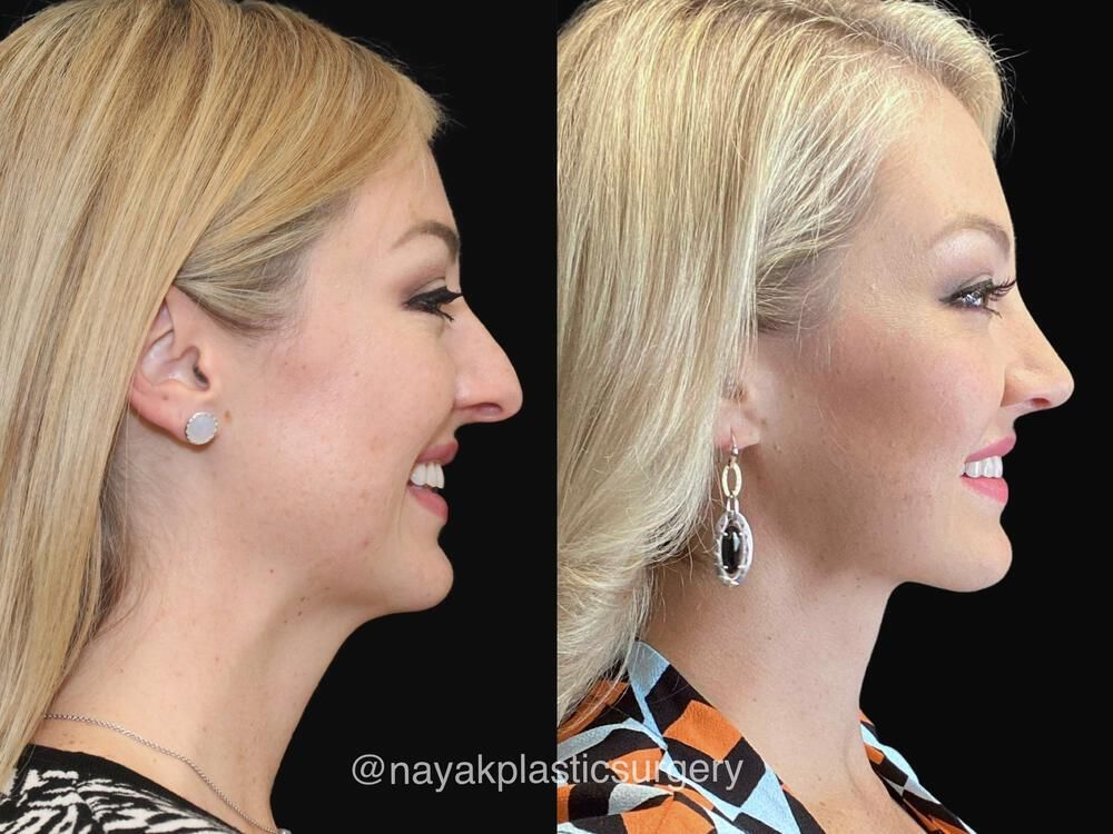 Rhinoplasty Before & After