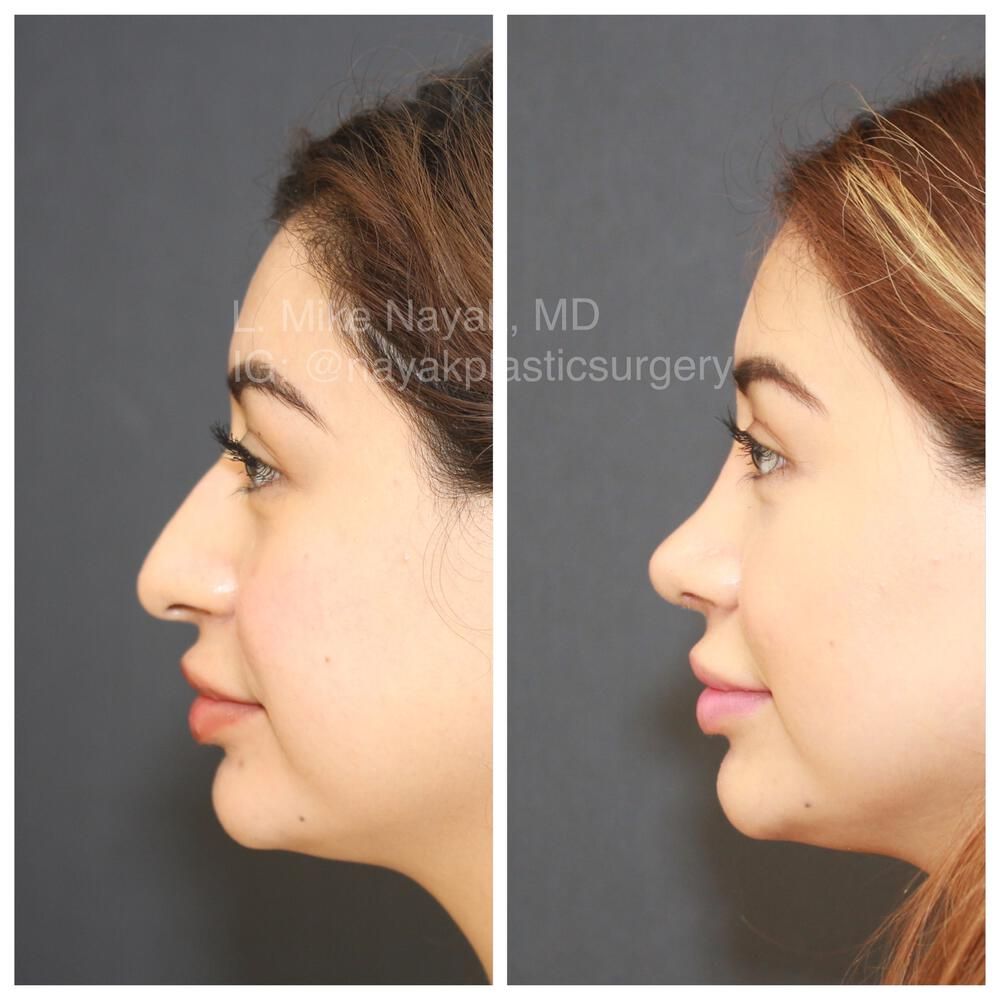 Rhinoplasty Before & After