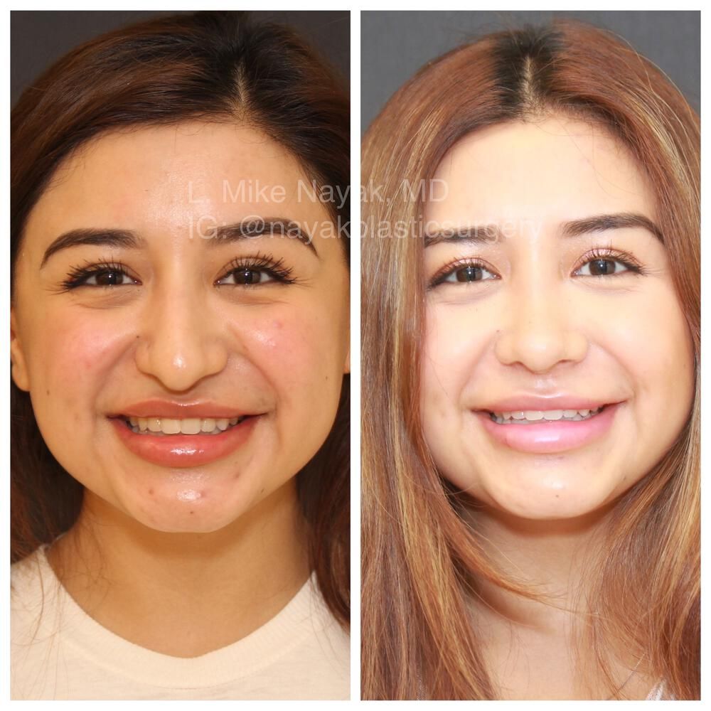 Rhinoplasty Before & After