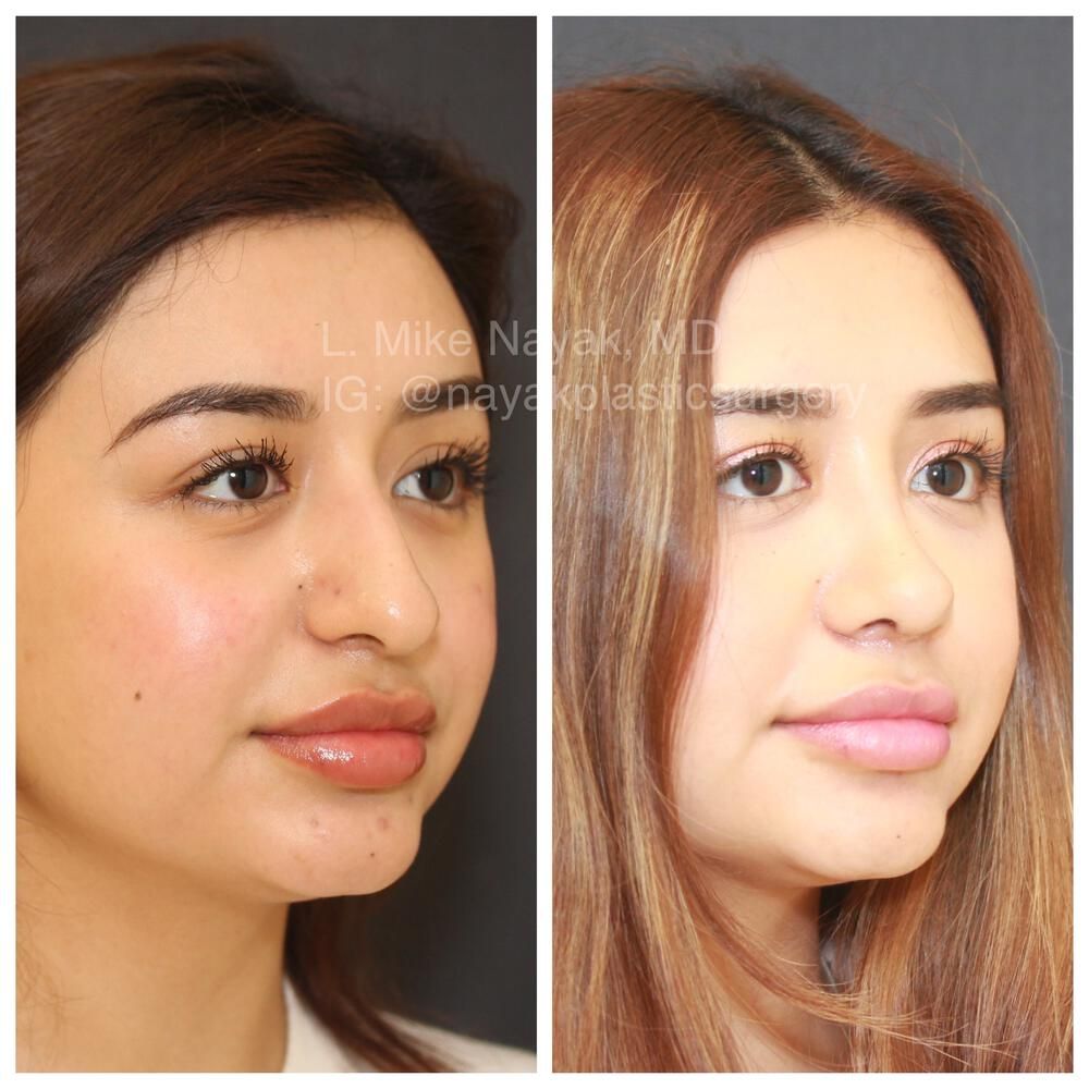 Rhinoplasty Before & After