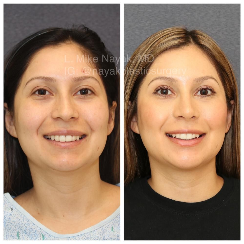 Rhinoplasty Before & After