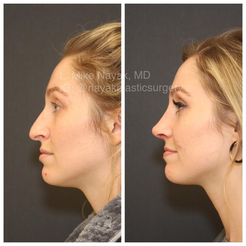 Rhinoplasty Before & After