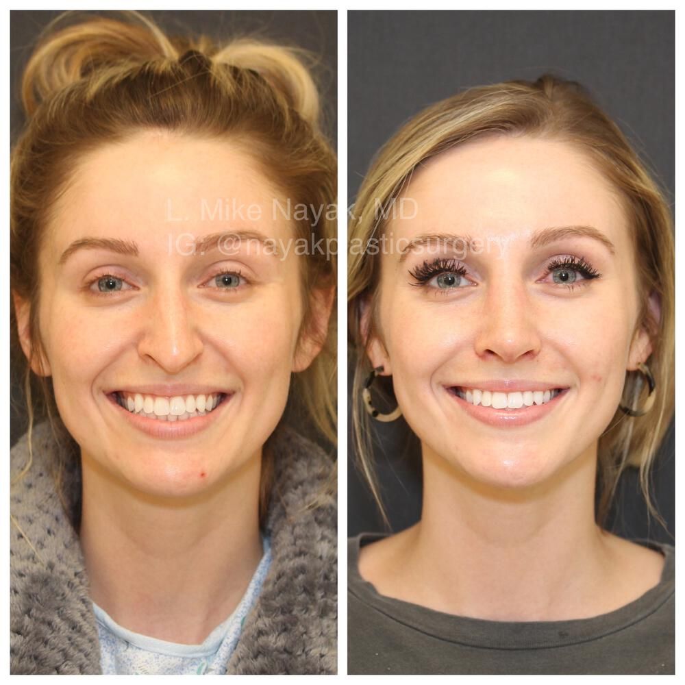 Rhinoplasty Before & After