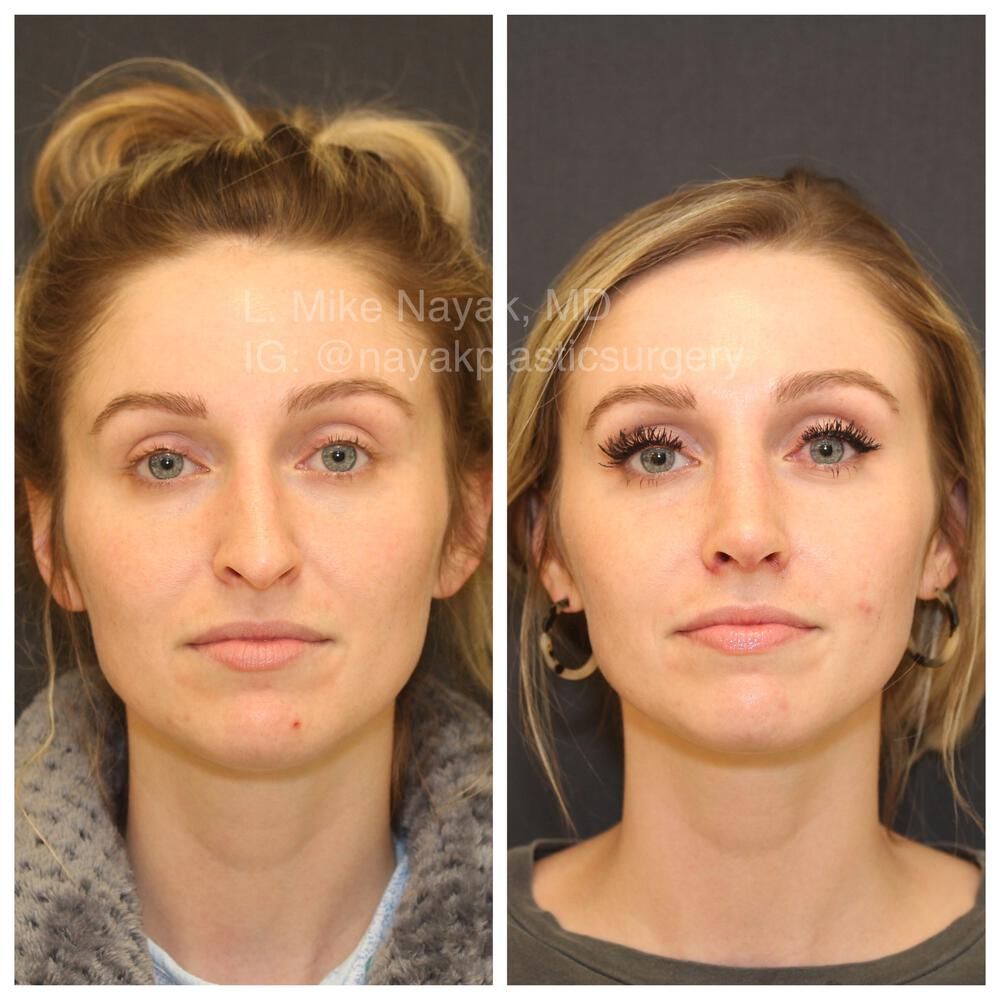 Rhinoplasty Before & After