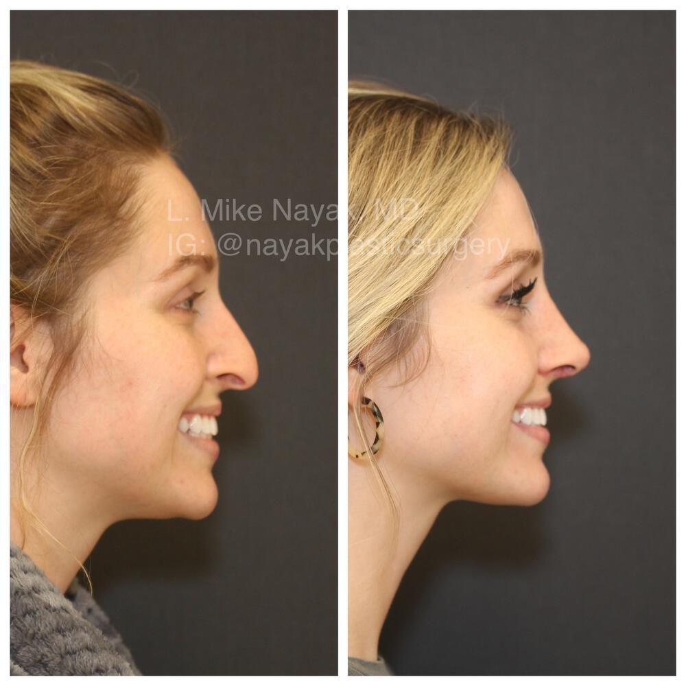 Rhinoplasty Before & After
