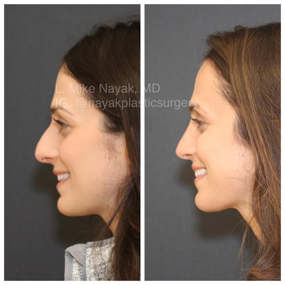 Rhinoplasty Before & After