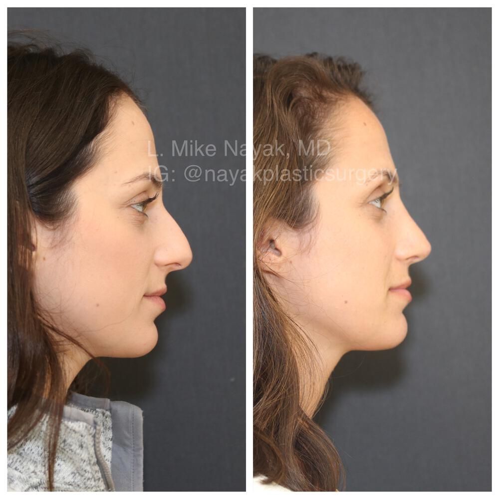 Rhinoplasty Before & After