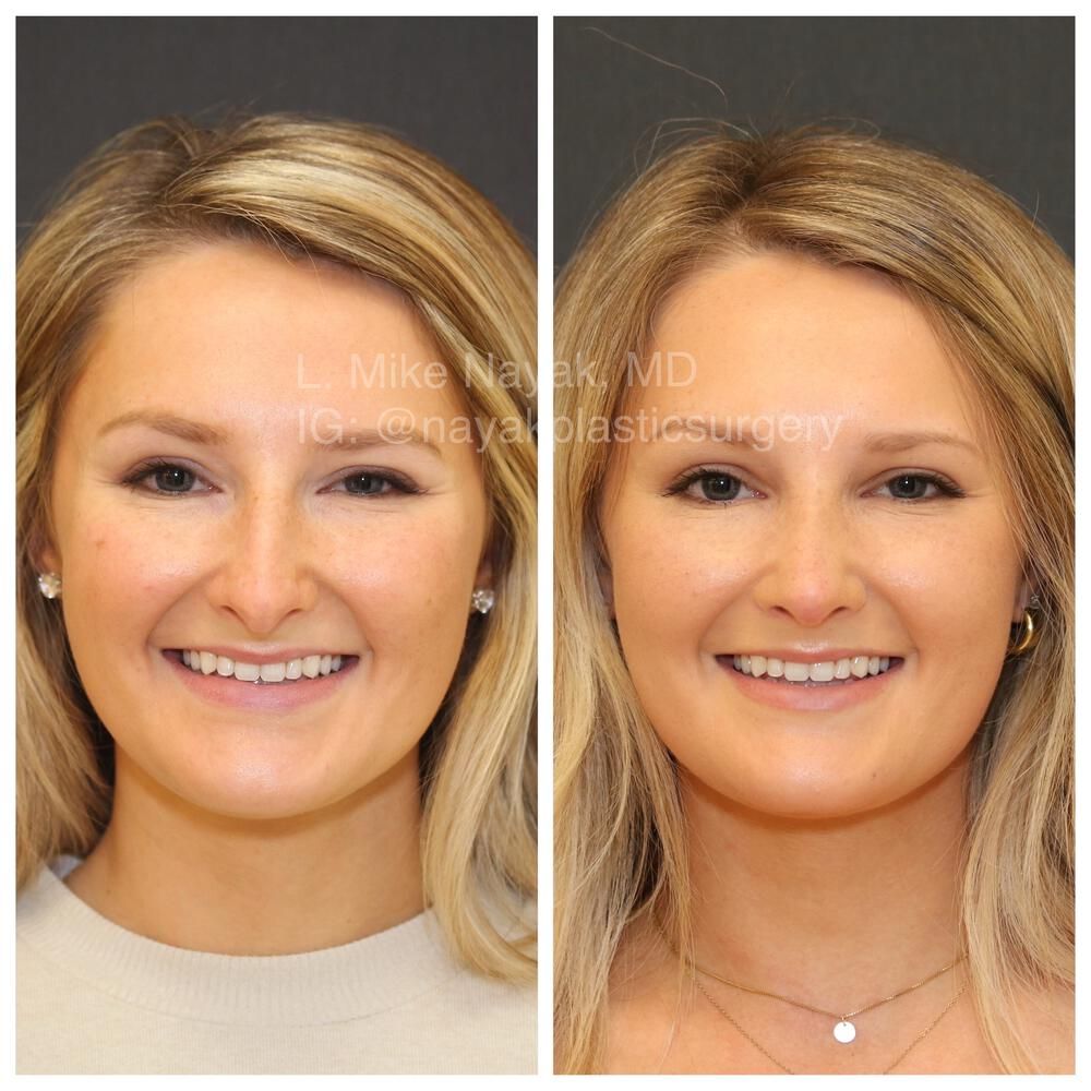 Rhinoplasty Before & After