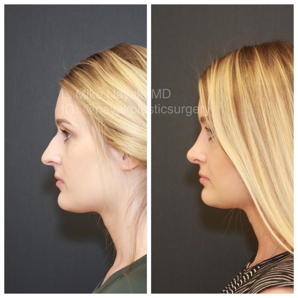 Rhinoplasty Before & After