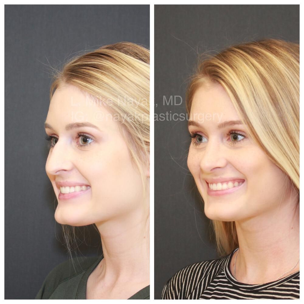 Rhinoplasty Before & After