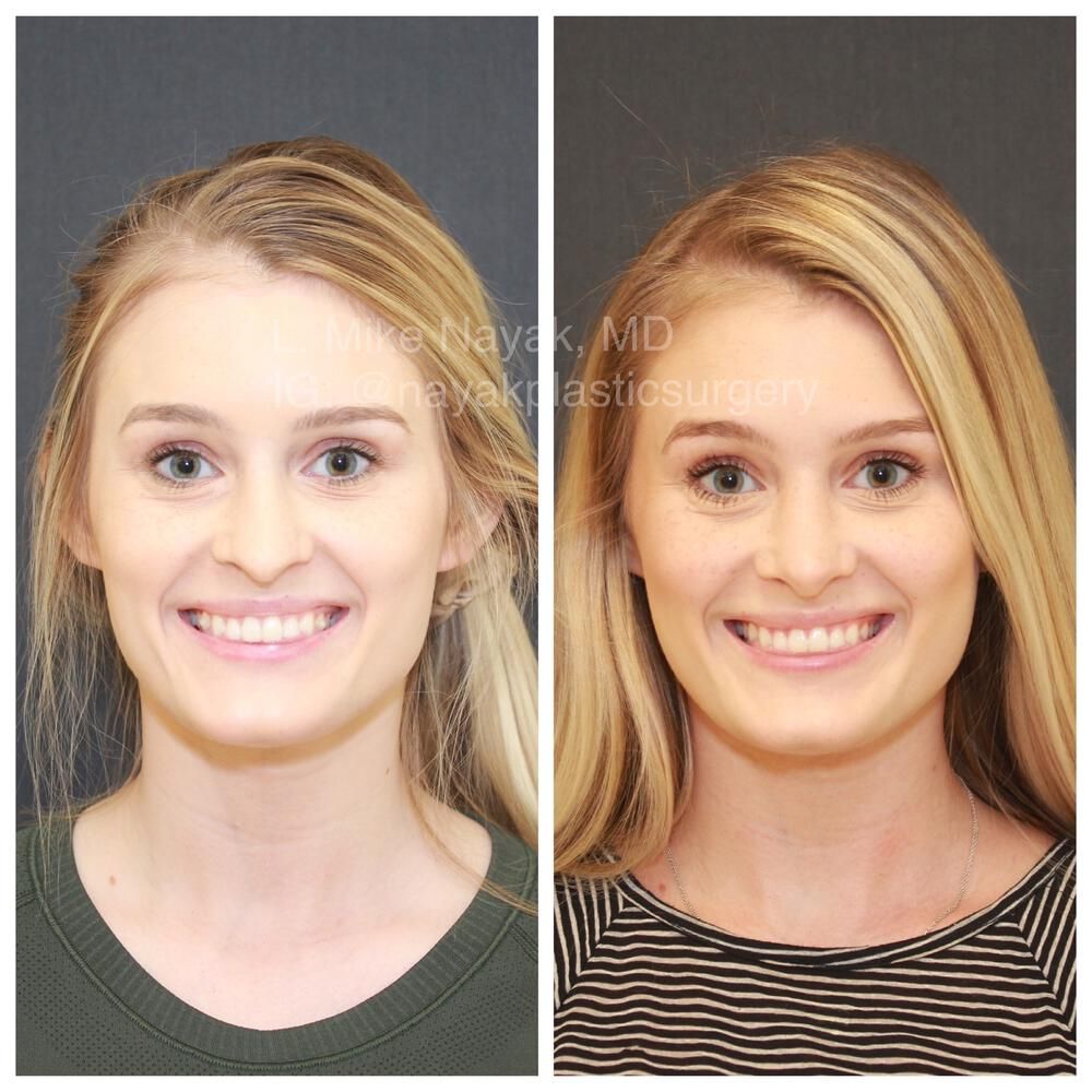Rhinoplasty Before & After