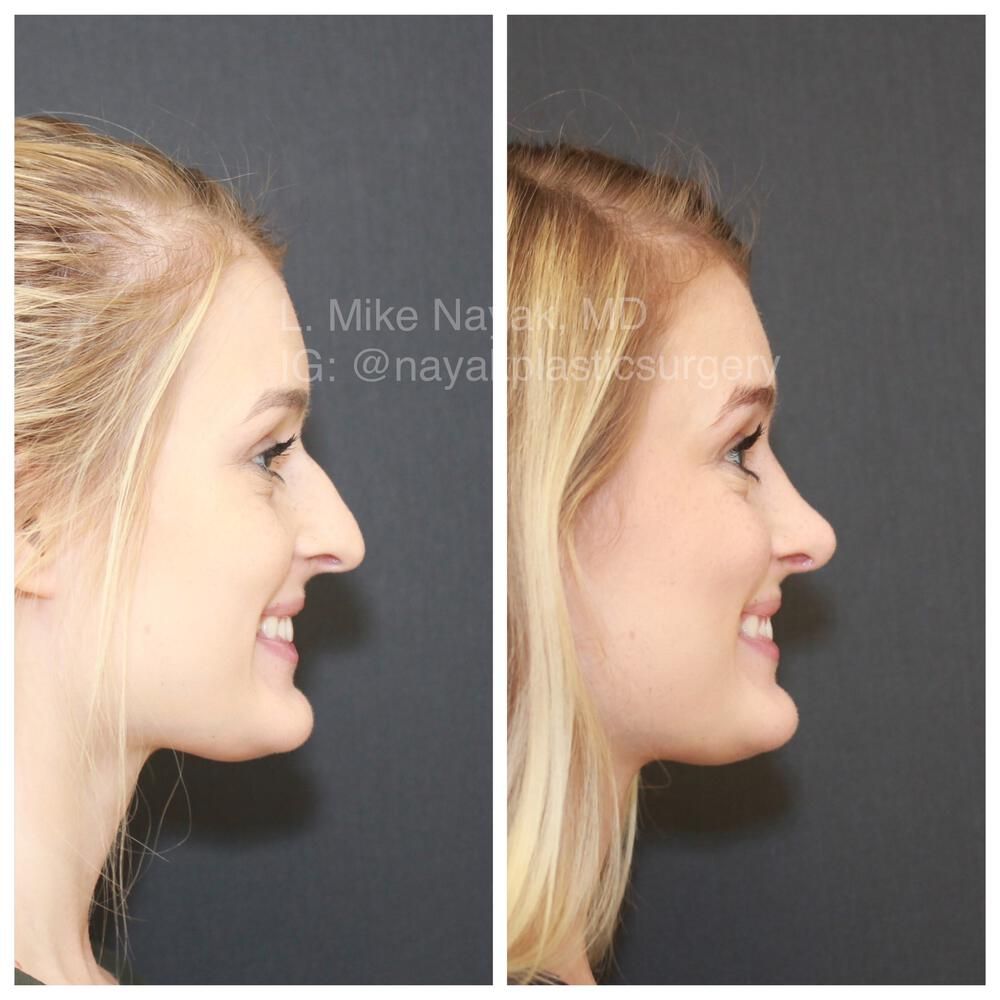 Rhinoplasty Before & After