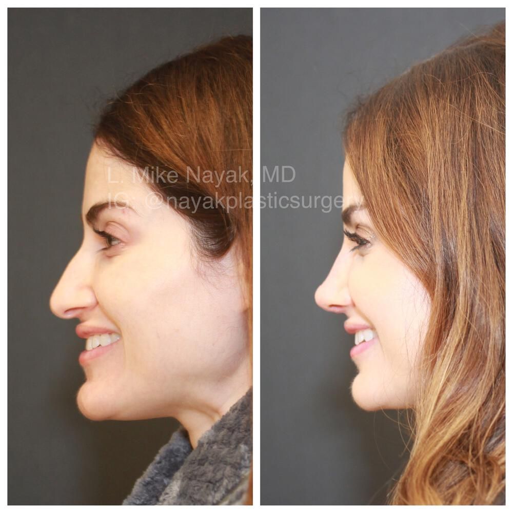 Rhinoplasty Before & After