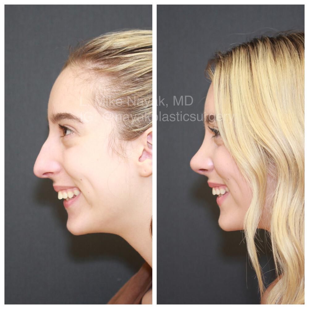 Rhinoplasty Before & After
