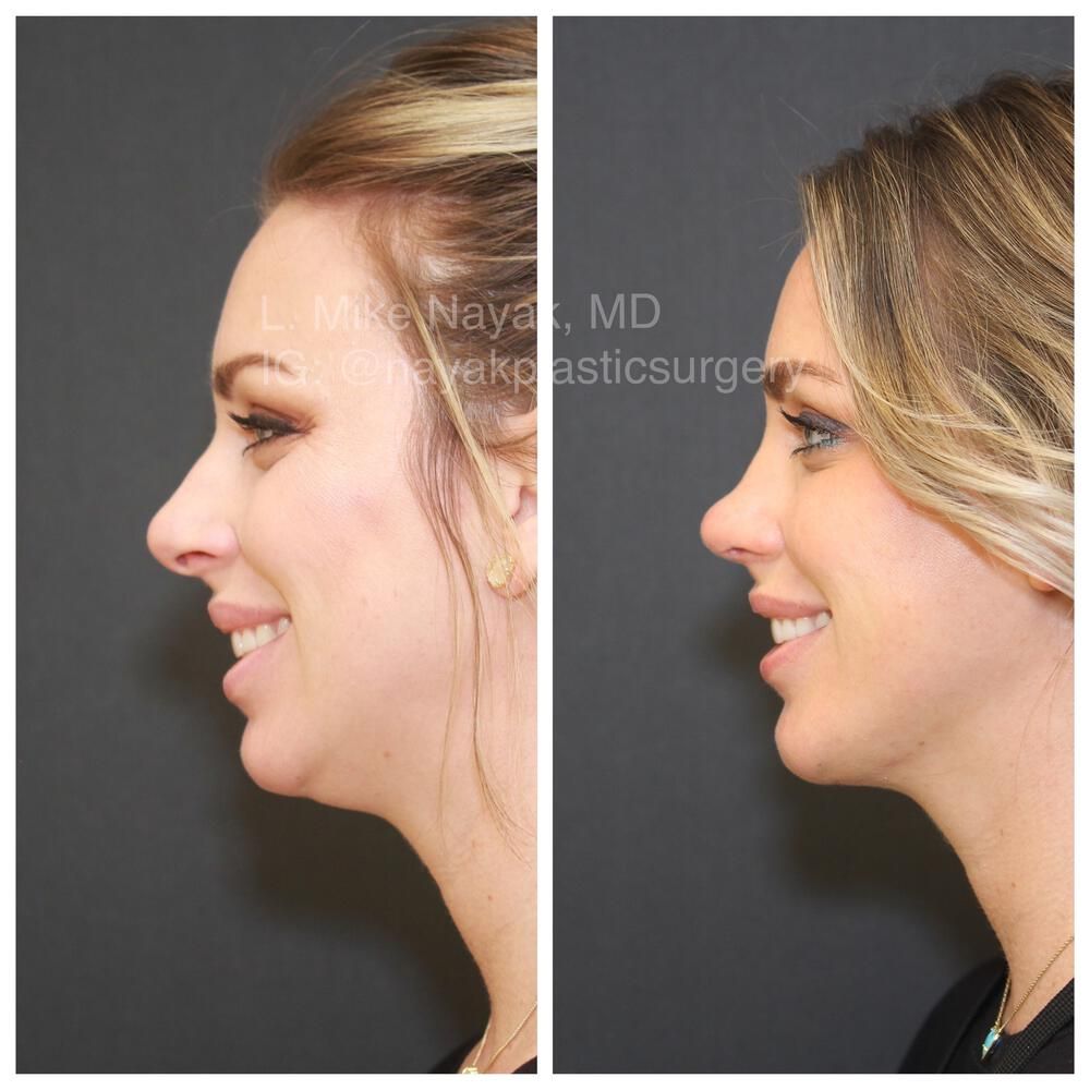 Rhinoplasty Before & After