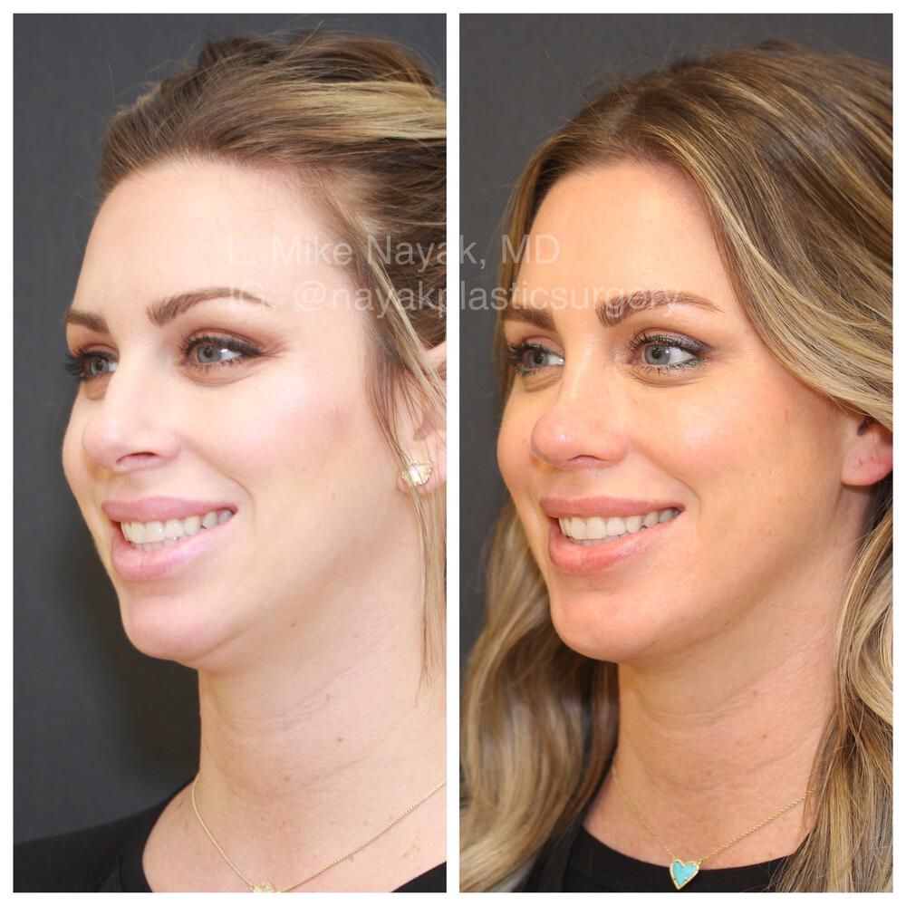Rhinoplasty Before & After