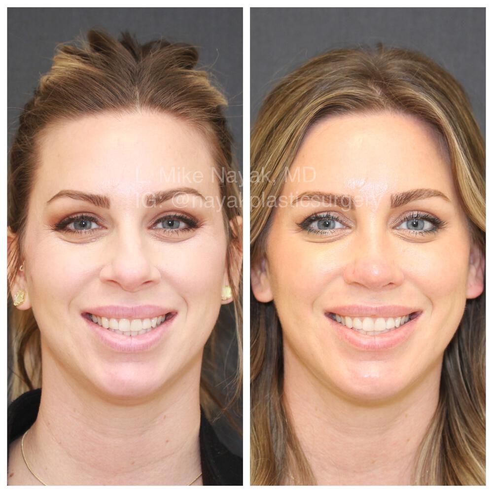 Rhinoplasty Before & After