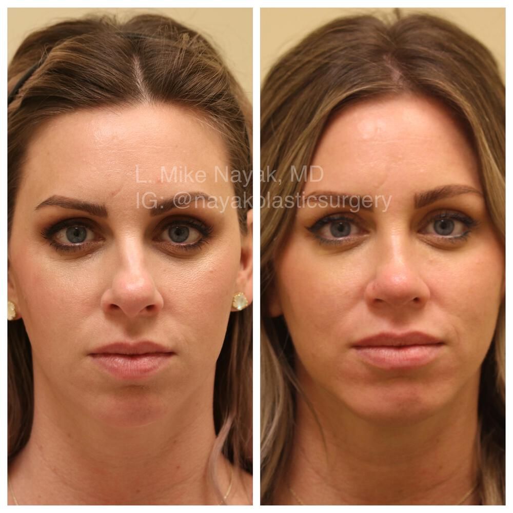 Rhinoplasty Before & After