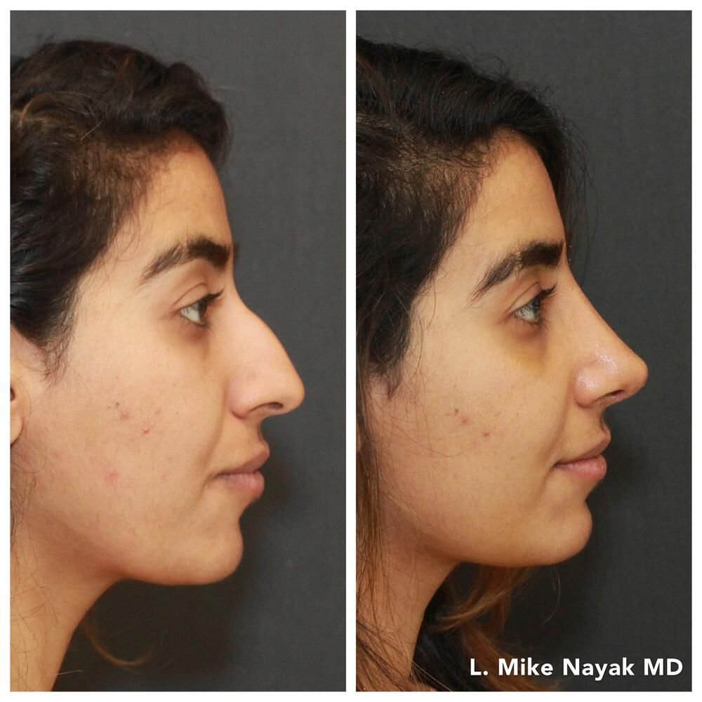 Rhinoplasty Before & After