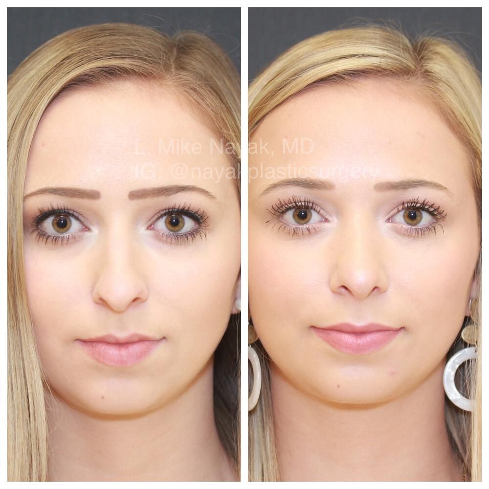 Rhinoplasty Before & After