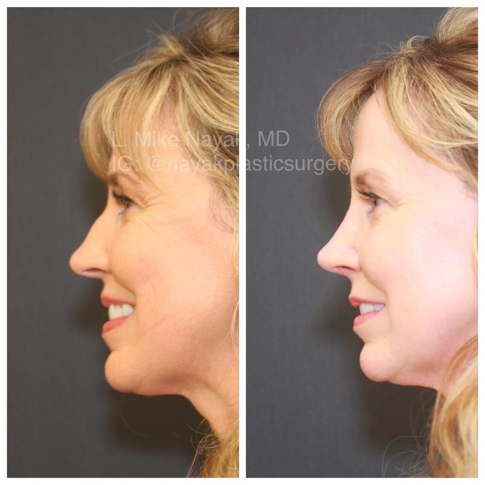 Rhinoplasty Before & After