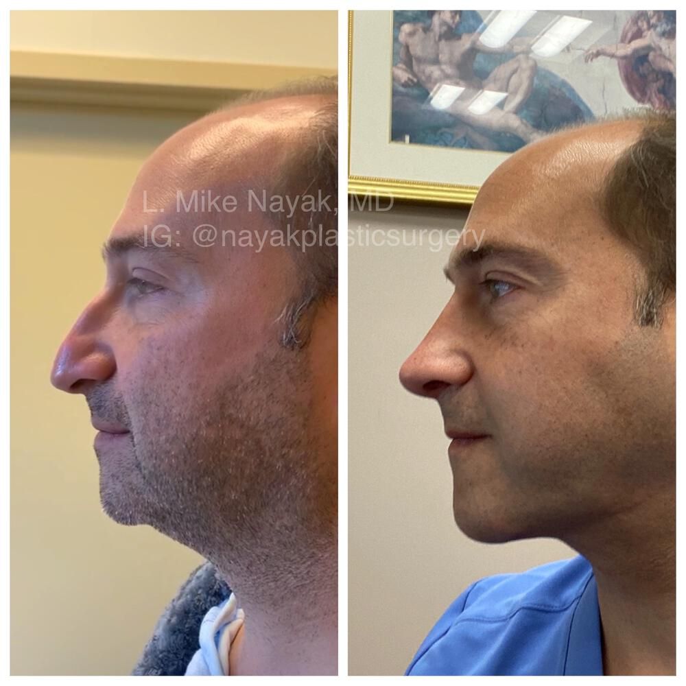 Rhinoplasty Before & After