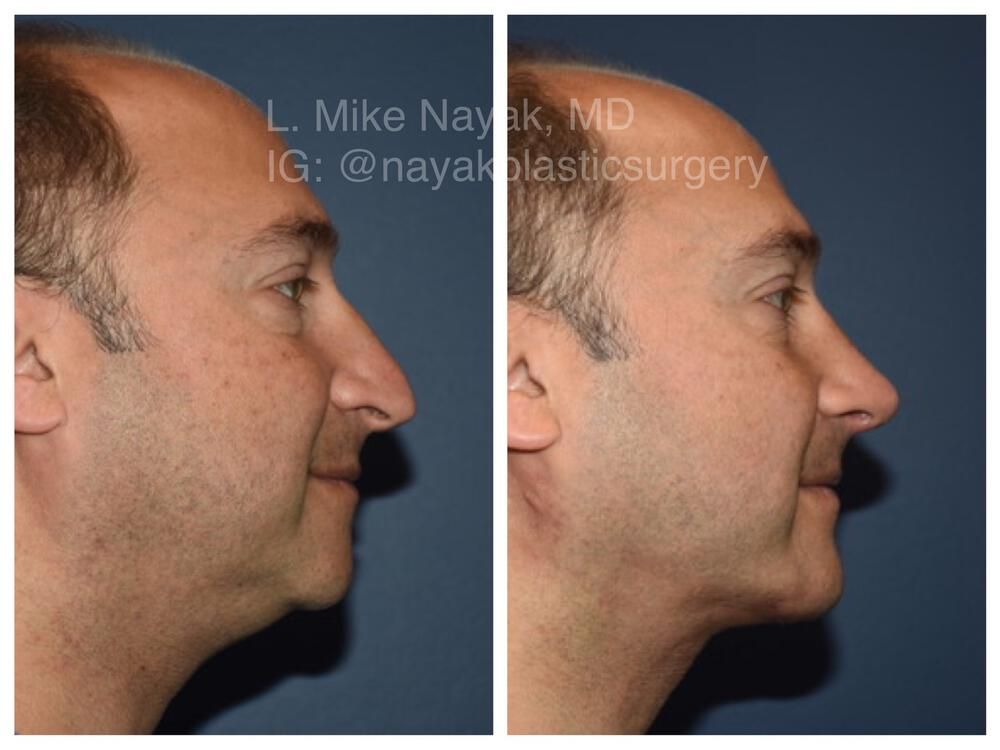 Rhinoplasty Before & After