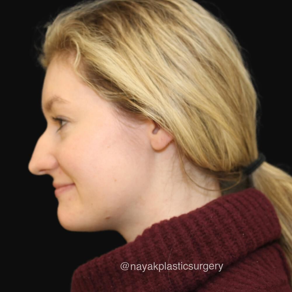 Rhinoplasty Before & After