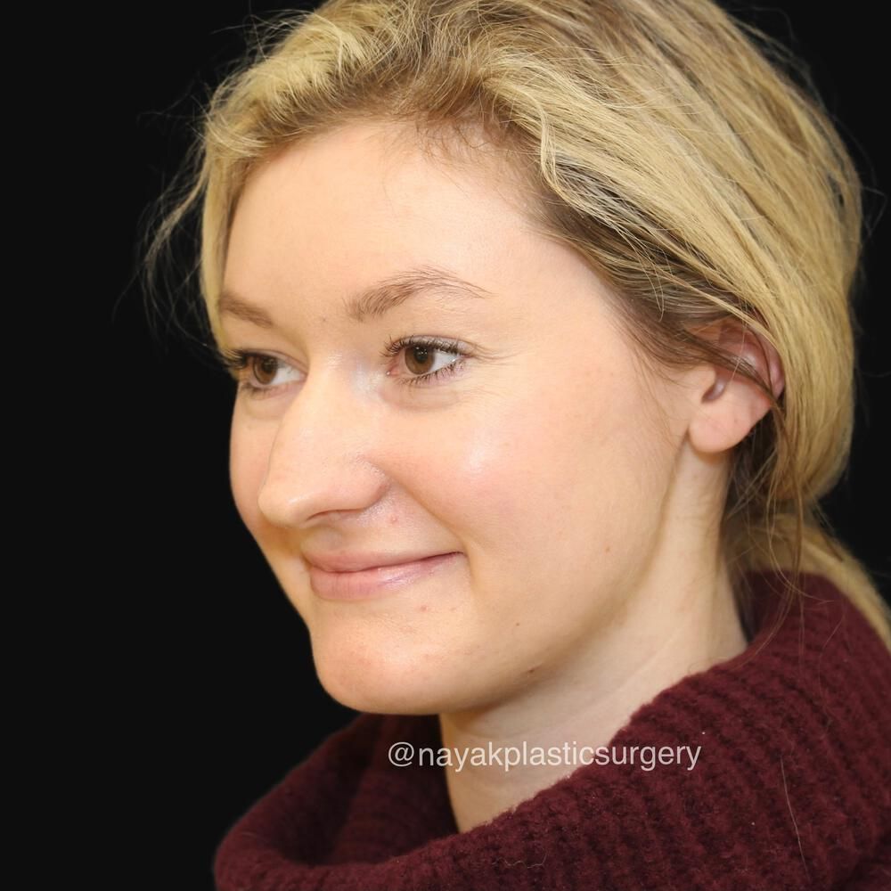 Rhinoplasty Before & After