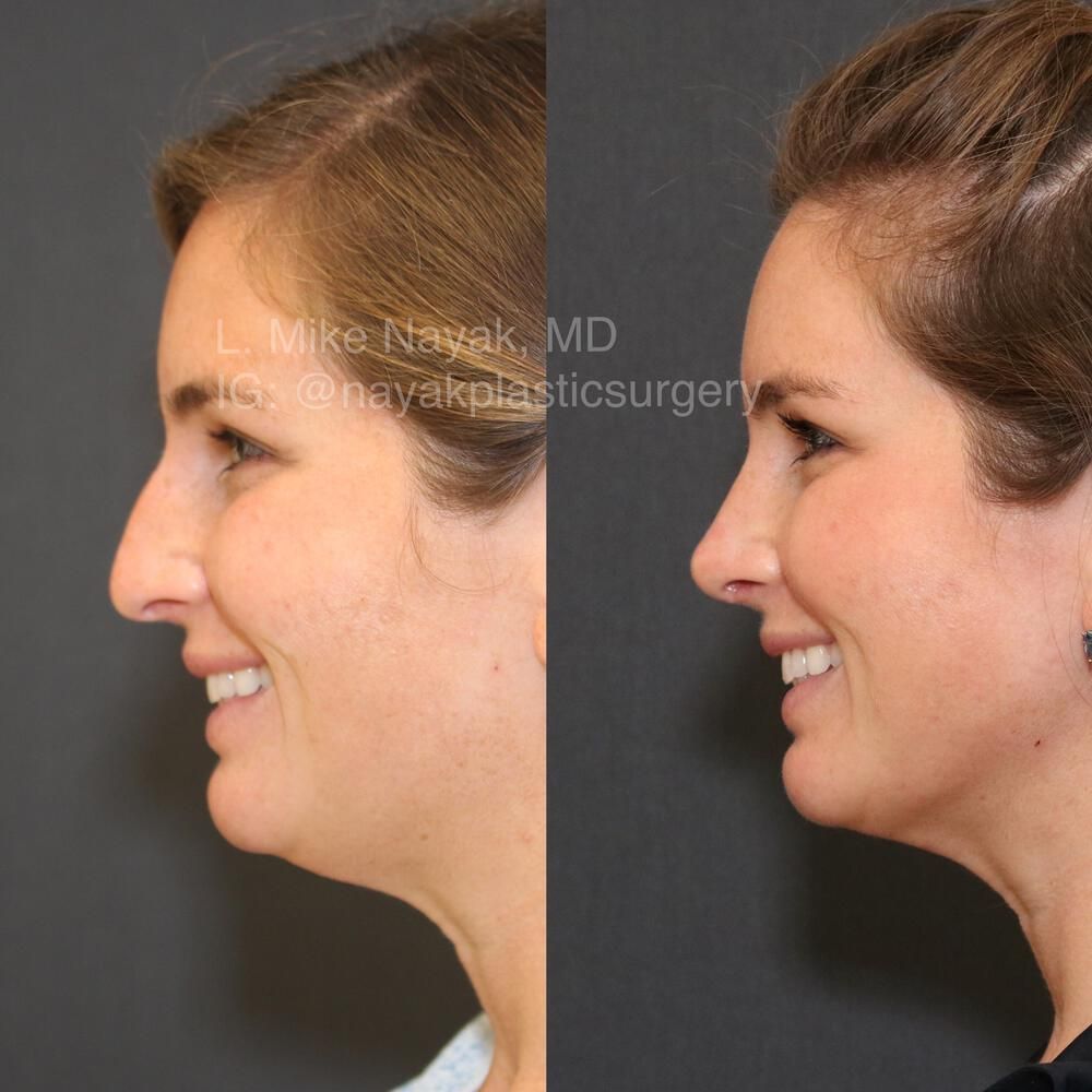 Rhinoplasty Before & After