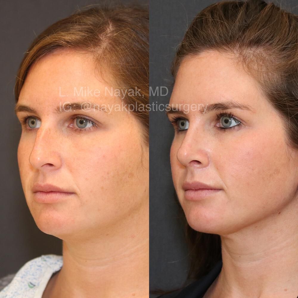 Rhinoplasty Before & After