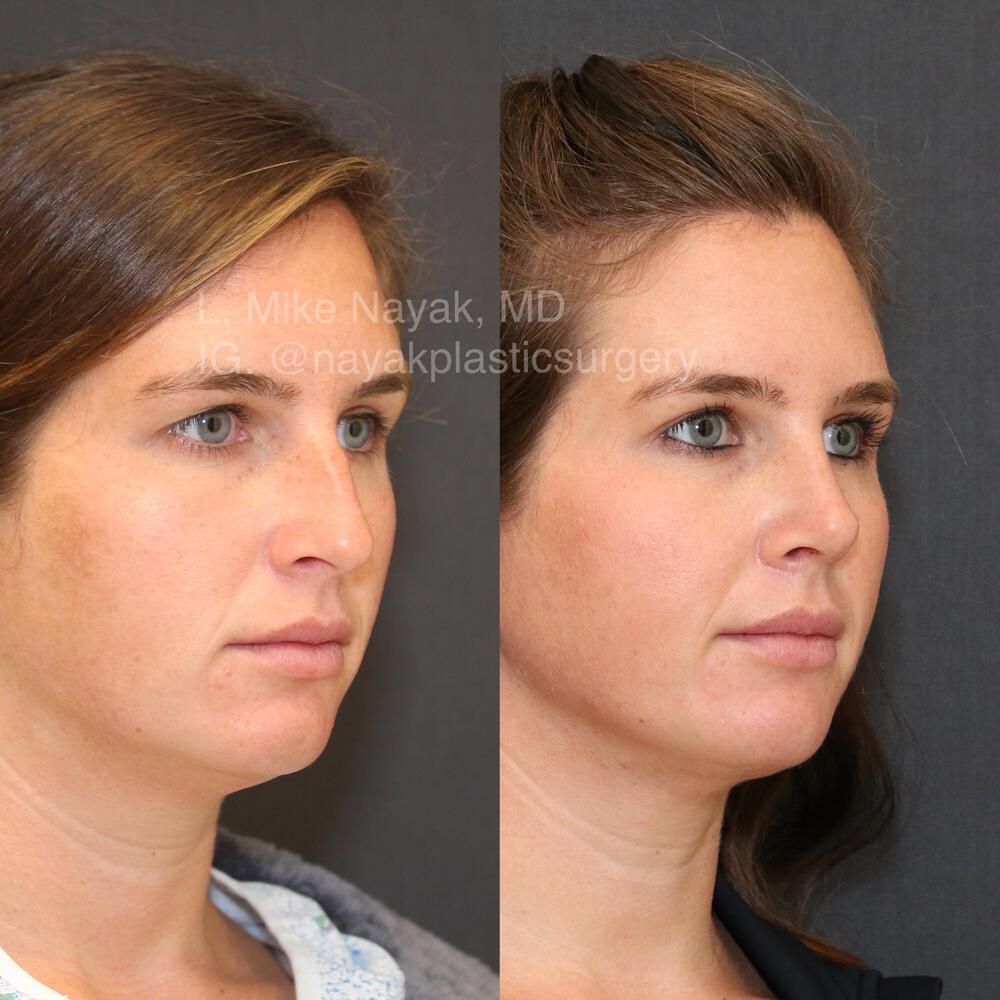 Rhinoplasty Before & After