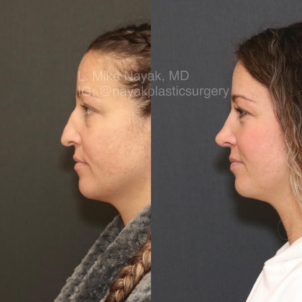Rhinoplasty Before & After