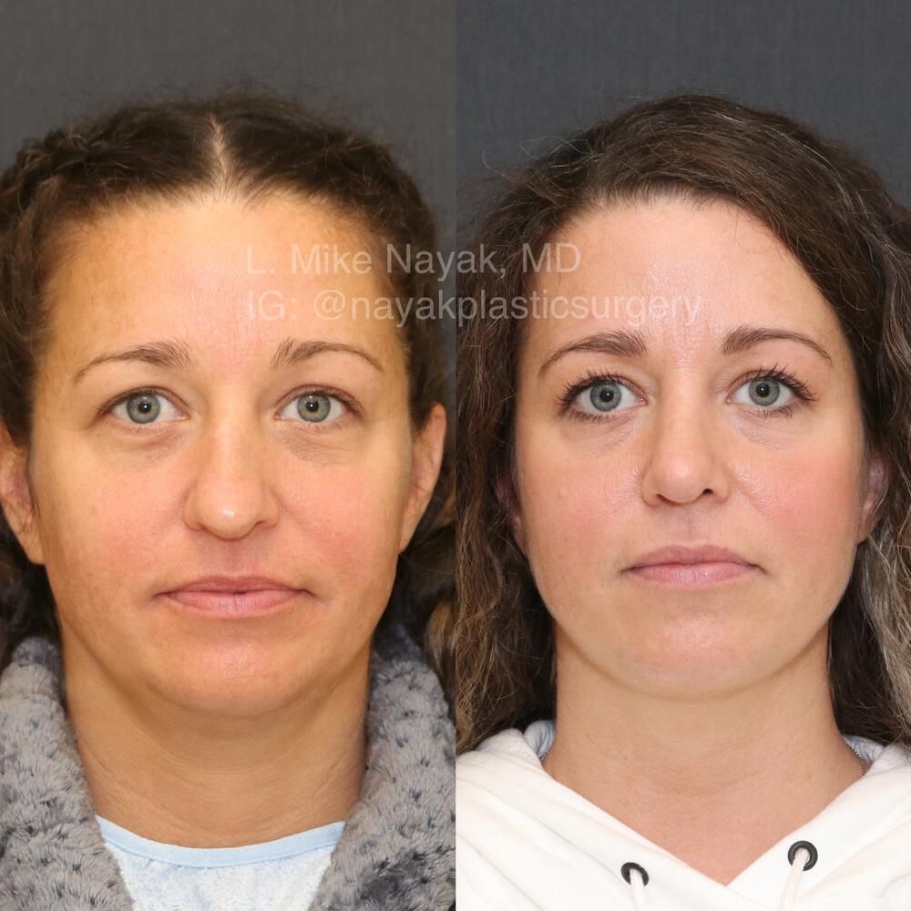 Rhinoplasty Before & After