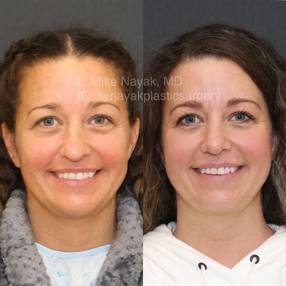 Rhinoplasty Before & After