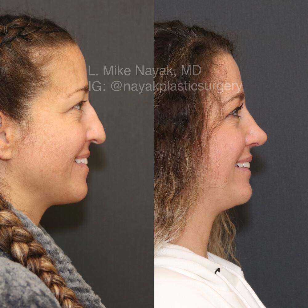 Rhinoplasty Before & After