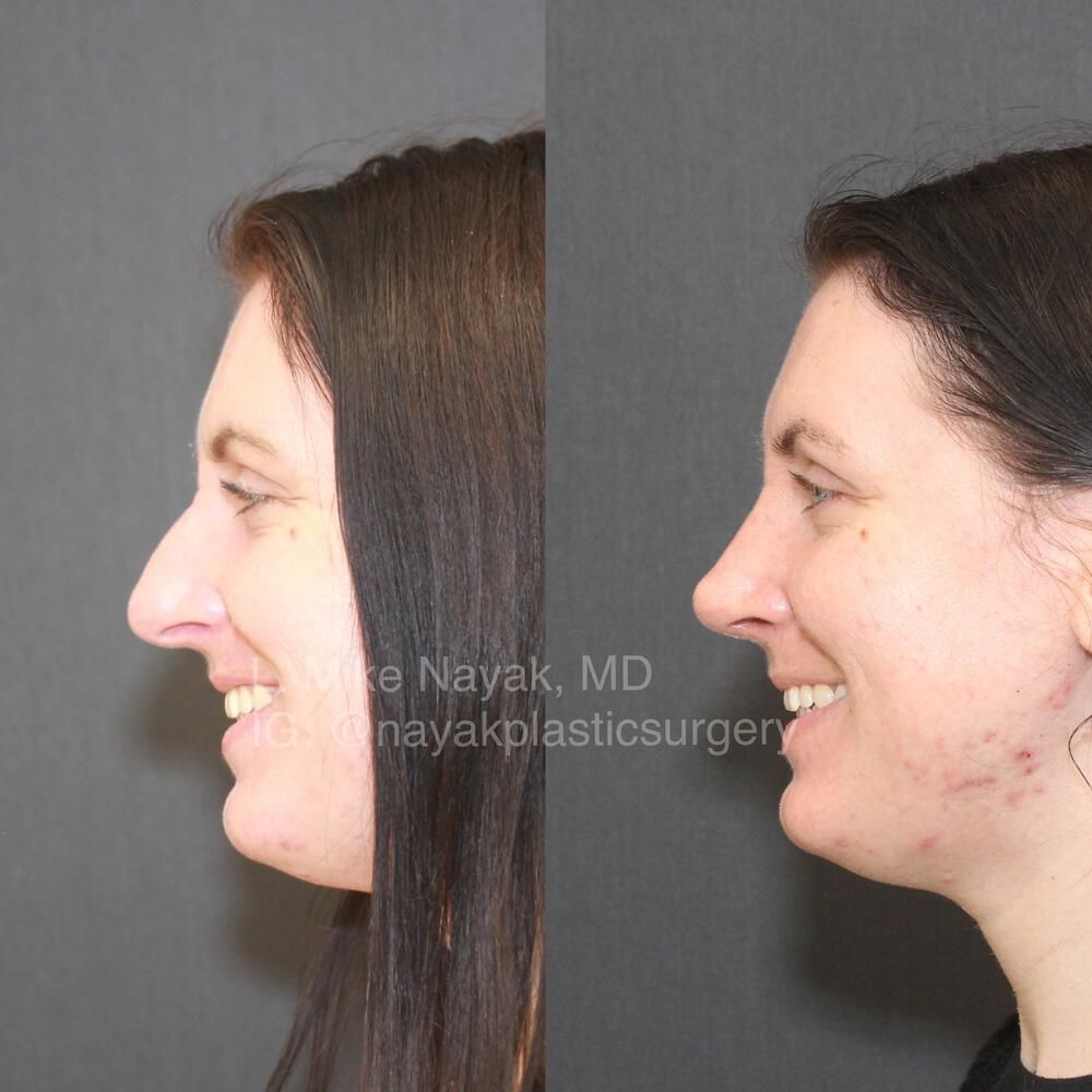Rhinoplasty Before & After