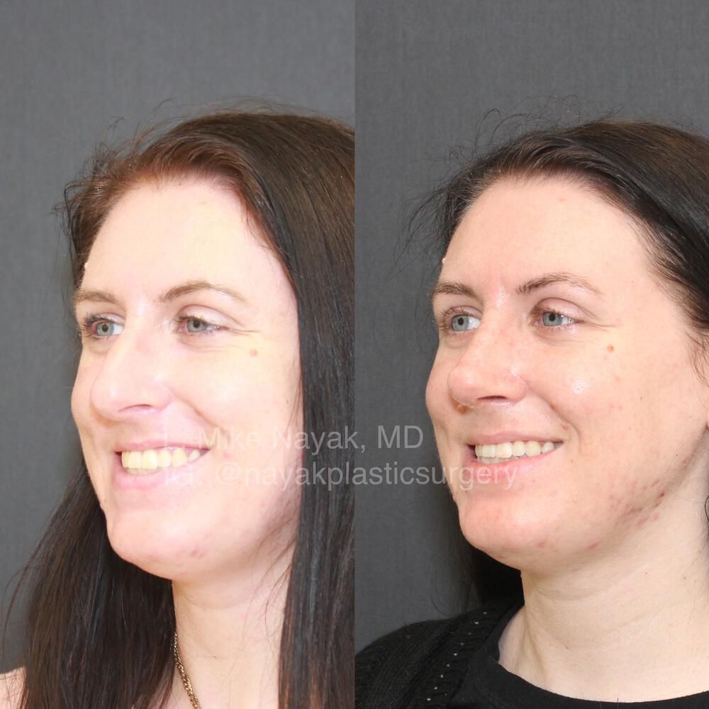 Rhinoplasty Before & After