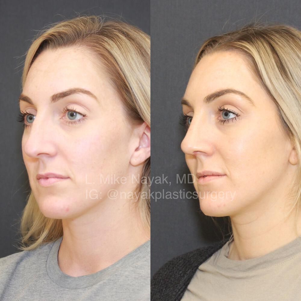 Rhinoplasty Before & After