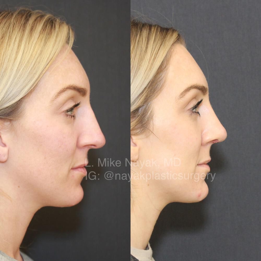 Rhinoplasty Before & After