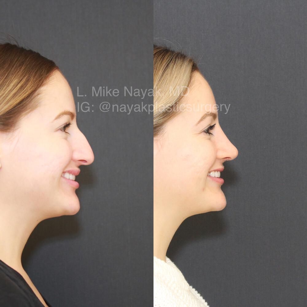 Rhinoplasty Before & After