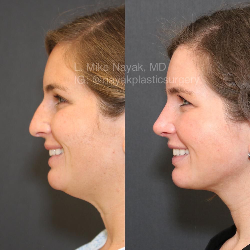 Rhinoplasty Before & After