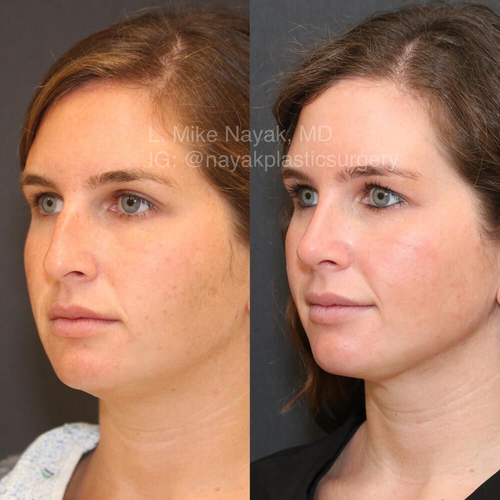 Rhinoplasty Before & After