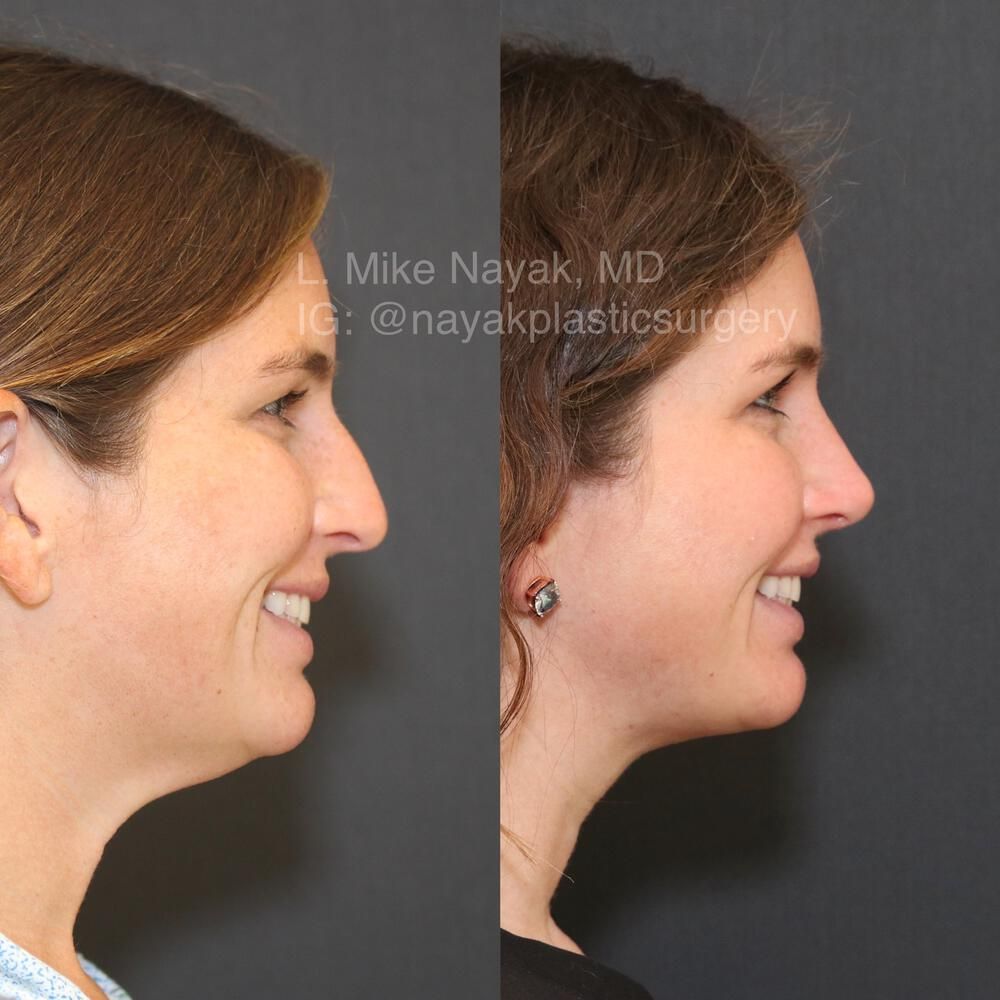 Rhinoplasty Before & After