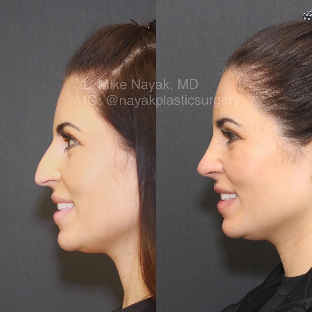 Rhinoplasty Before & After