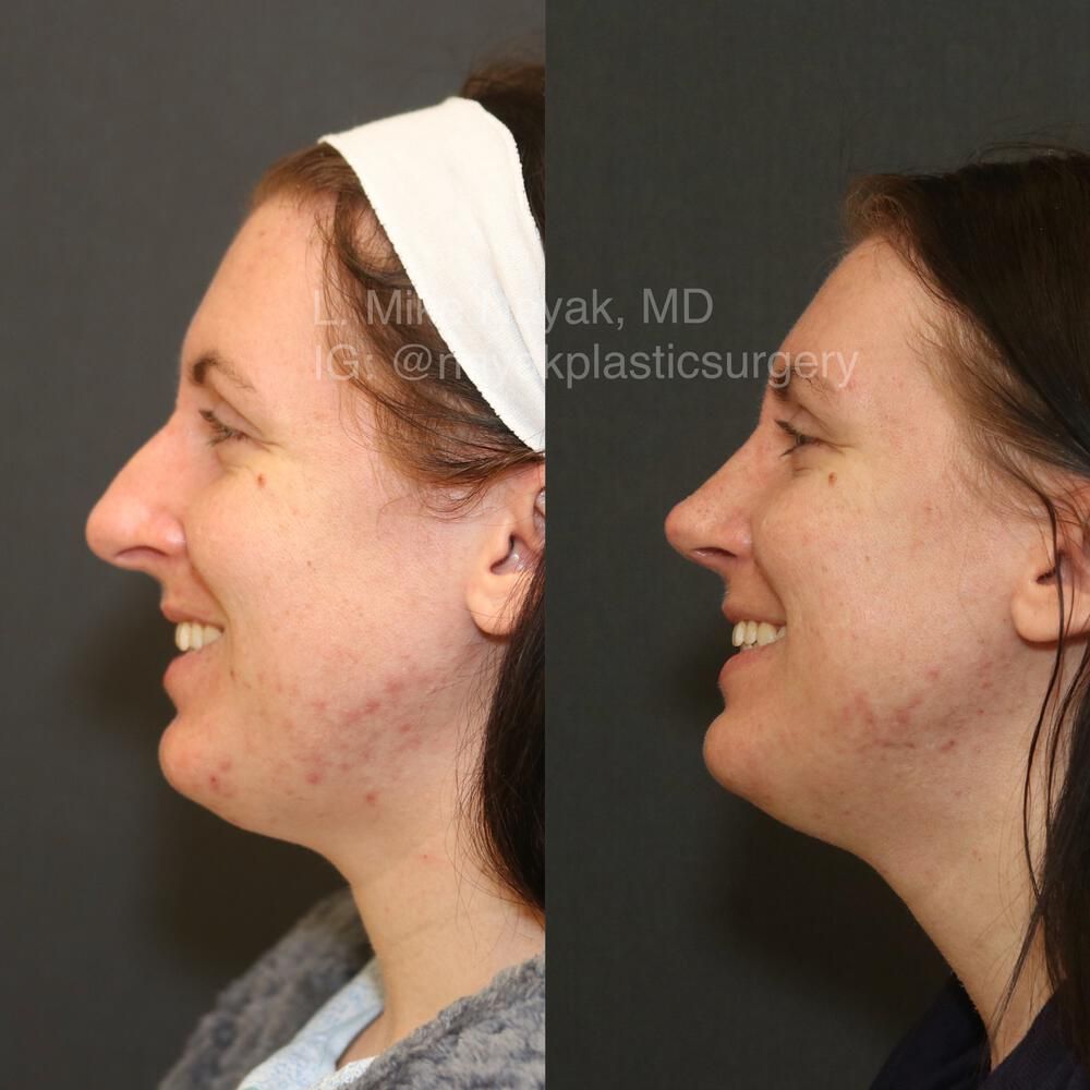 Rhinoplasty Before & After