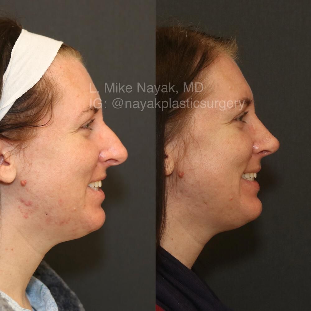 Rhinoplasty Before & After