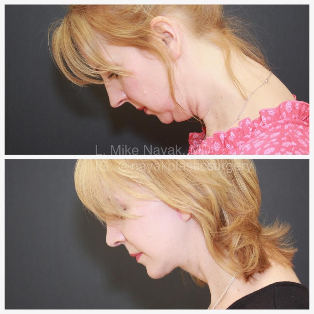 Rhinoplasty Before & After
