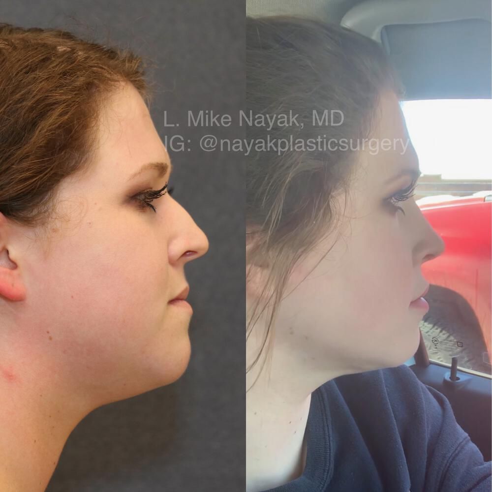 Rhinoplasty Before & After
