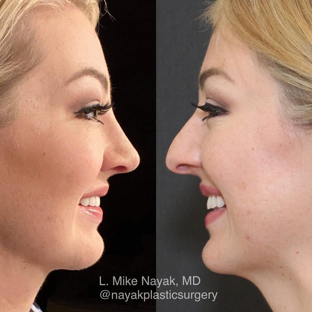 Rhinoplasty Before & After